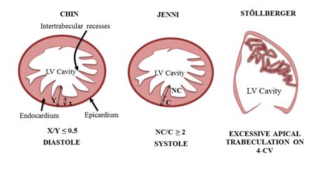 lv non-compaction cardiomyopathy|Lv non compaction criteria.